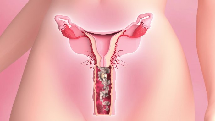 AE 工程妇科疾病 女性器官 卵巢