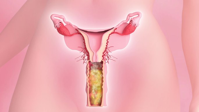 妇科疾病 子宫 女性器官卵巢 妇科