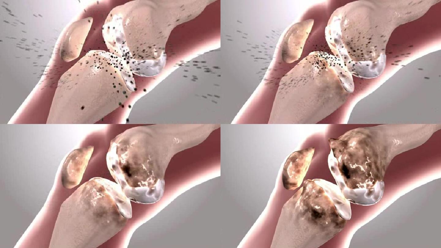 膝关节形成骨刺增生 破坏滑膜