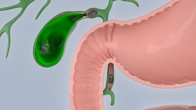 胆囊 胆结石 胆汁 消化系统