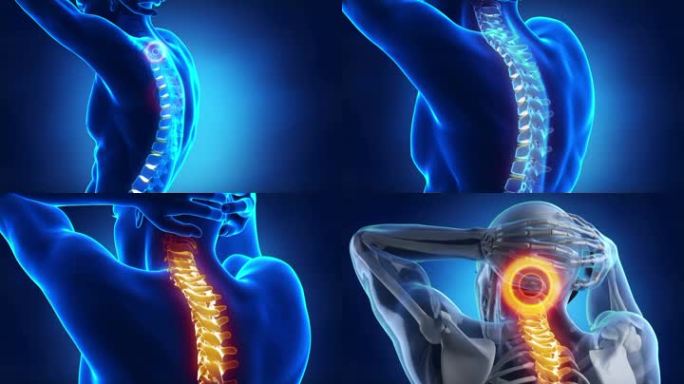 颈部疼痛从脊柱椅辐射到颈部。