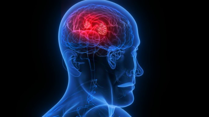 AE工程大脑肿瘤 头痛 大脑神经 脑肿瘤