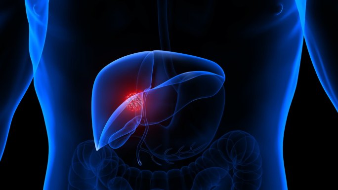 AE 工程肝脏肿瘤 肝病 肝癌