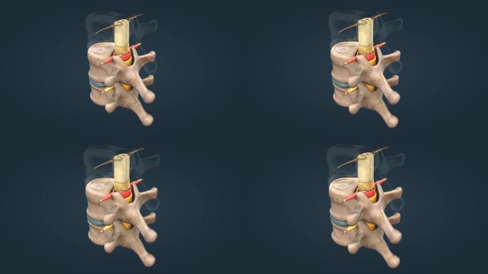脊髓髓质腰椎间盘神经根软脑膜硬脑膜