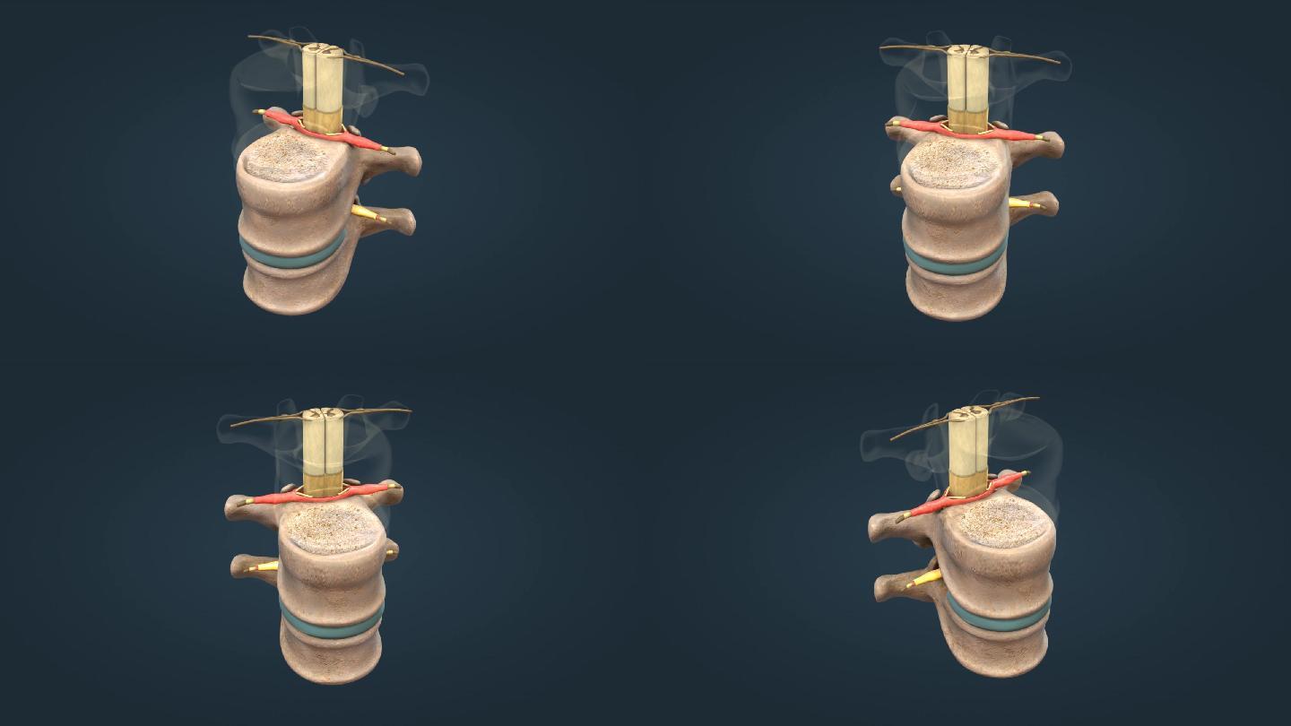 脊髓神经椎间盘腰椎疼痛三维动画
