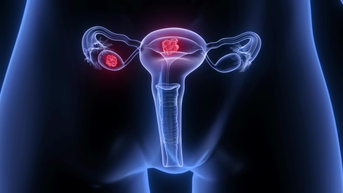 宫颈癌 子宫肌瘤 卵巢囊肿