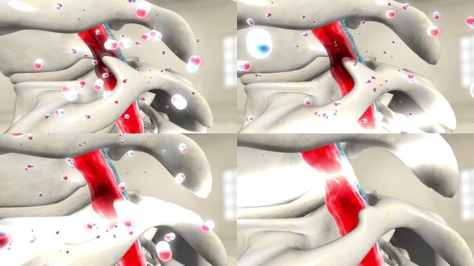 消融骨刺解除血管压迫颈椎