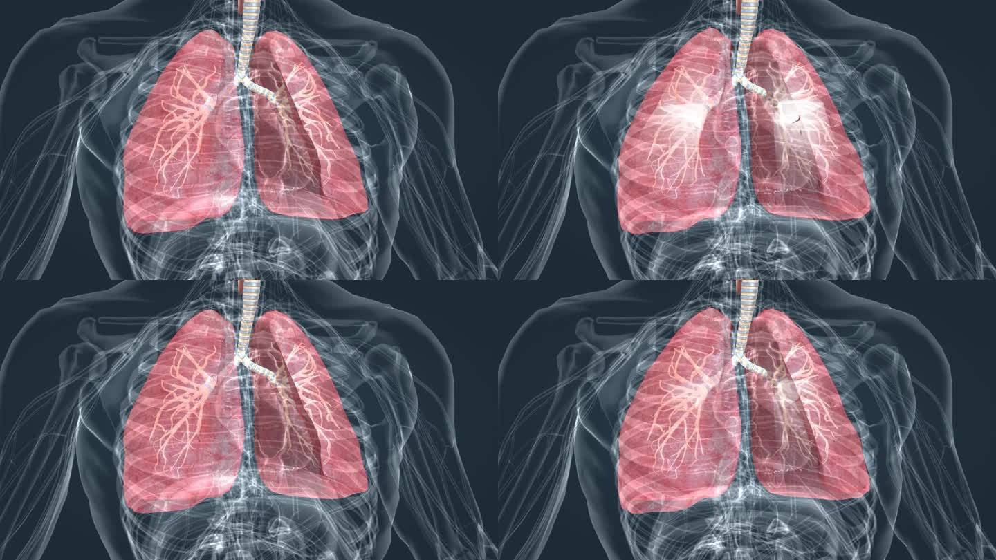 肺功能肺炎气管炎支气管肺炎三维特效素材