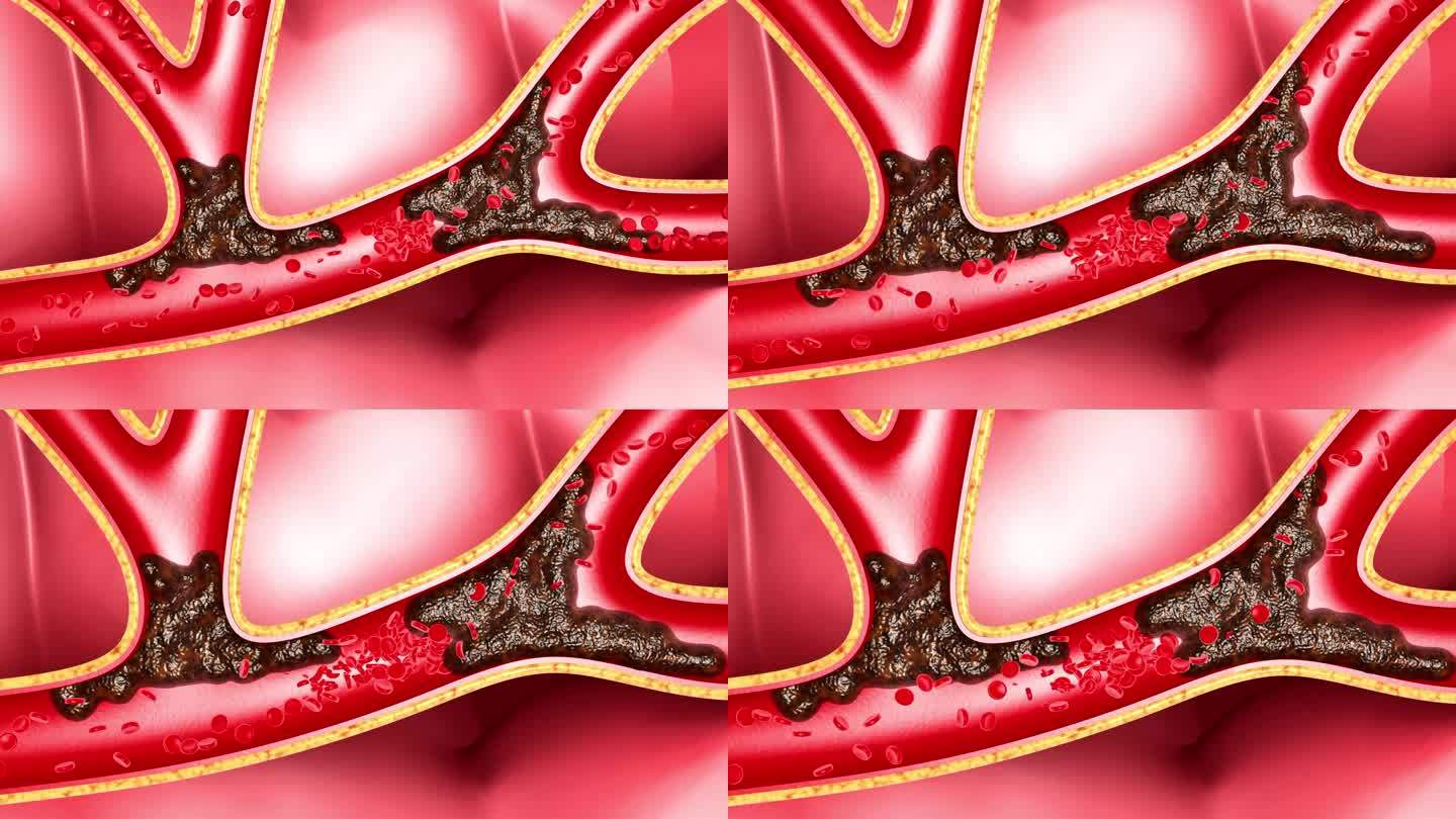 血液垃圾血管堵塞 自由基 粥样硬化