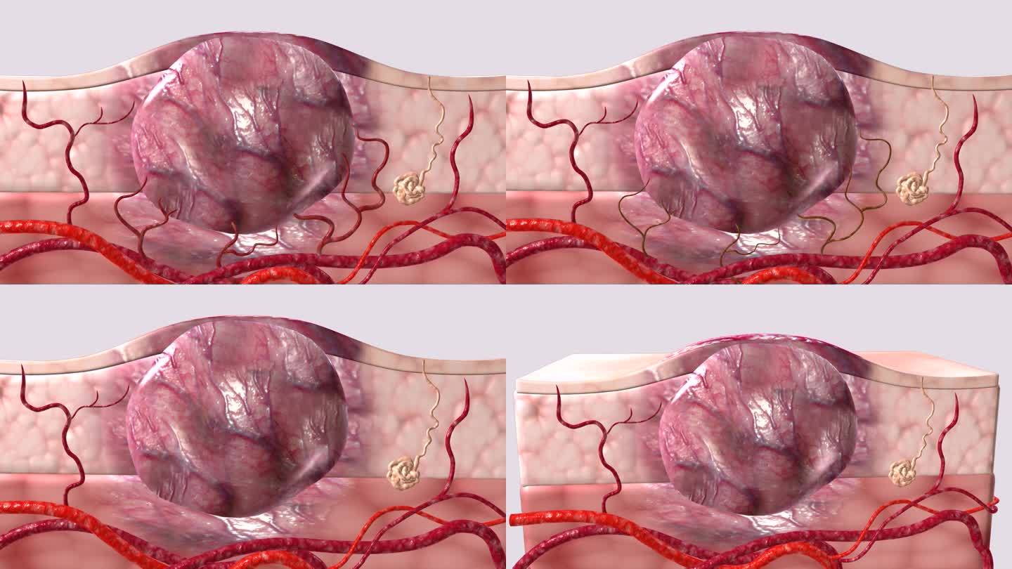 瘤体机体无法正常提供生长环境逐渐萎缩消融