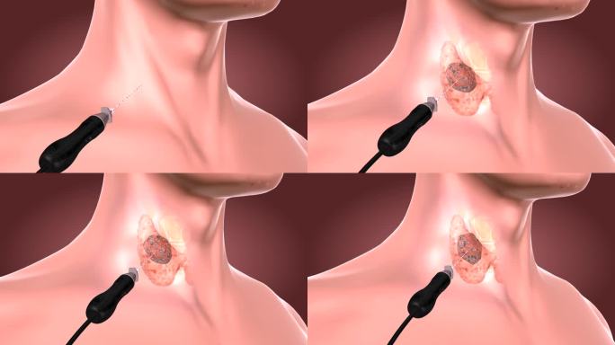 消融针直接介入到甲状腺结节内使腺体消失