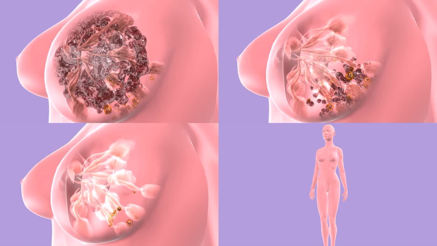 乳房硬块乳腺炎肿瘤胀痛消失 气色明显改善