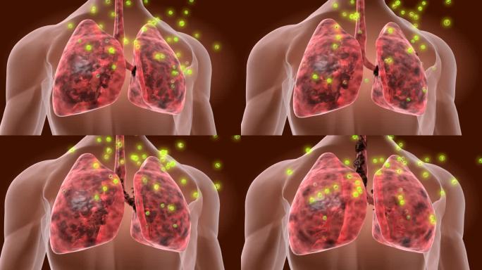 哮喘用中药离子高效渗透吸收使双肺恢复功能