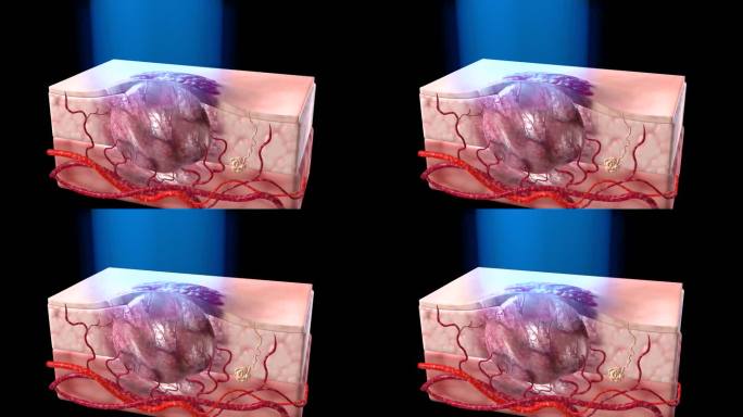 三D长脉冲激光对皮肤瘤体深部进行照射治疗