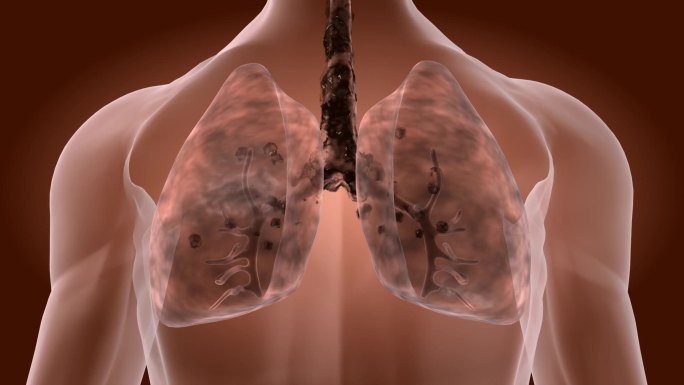 肺部感染通过清肺排垢进行修复 肺变好康复