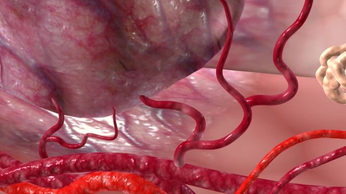 瘤体内壁腔隙及静脉血管腔形成大量血栓