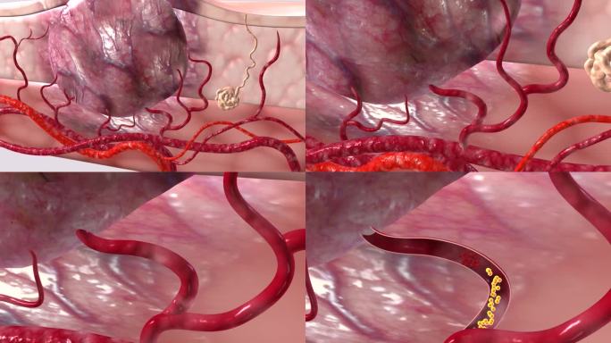 瘤体内壁腔隙及静脉血管腔形成大量血栓