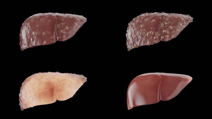 脂肪肝 肝囊肿 肝腹水 病变及康复 通道