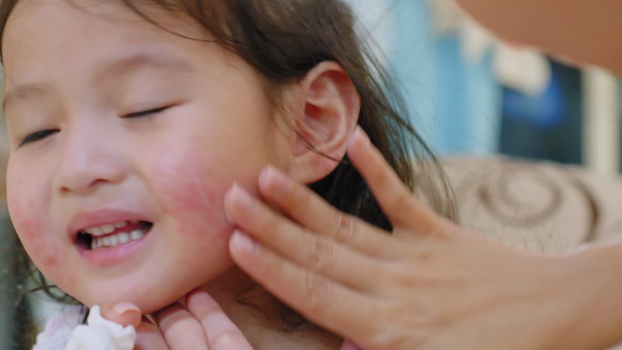 特写婴儿脸有皮疹通常出现在蹒跚学步的女孩身上。过敏：儿童脸颊发红