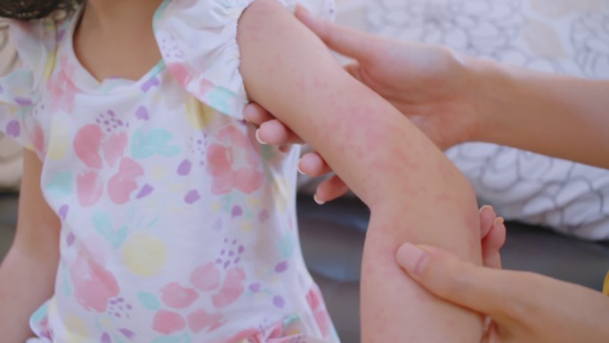 皮疹通常出现在蹒跚学步的女孩身上。过敏：儿童脸颊发红