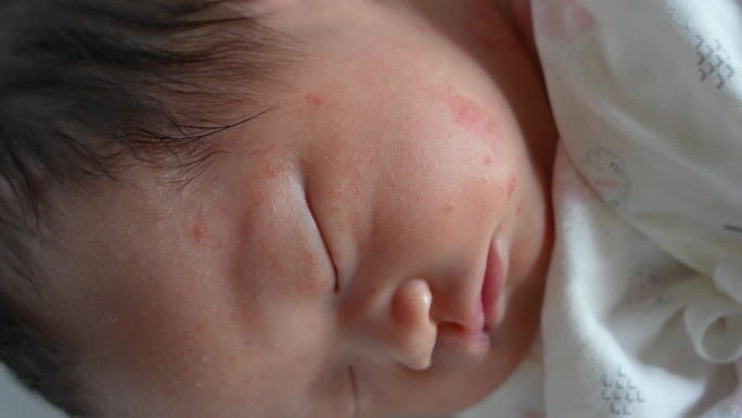 新生儿婴儿长湿疹