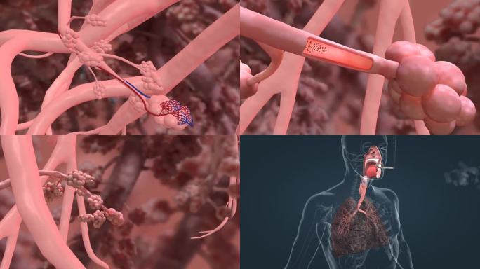 肺癌 肺炎 吸烟 吸烟对肺的影响三维动画