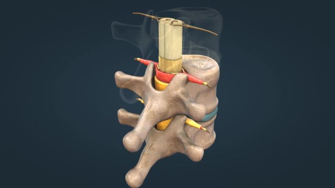 神经系统 椎间盘突出 脊髓 三维动画