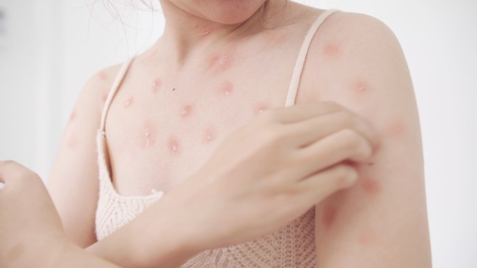 猴痘流行的概念是，感染猴痘病毒后，亚洲白人女性皮肤出现红斑、脓疱和水疱，瘙痒。
