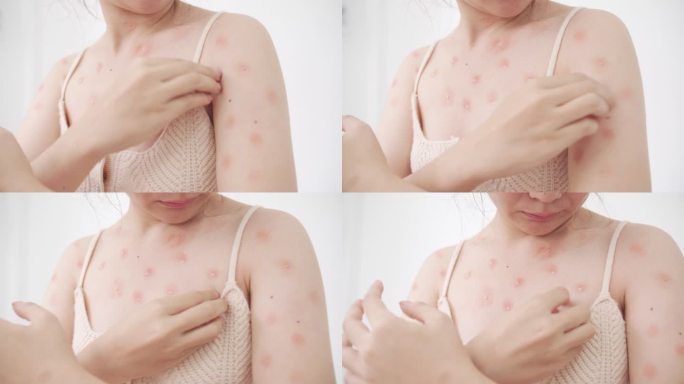 猴痘流行的概念是，感染猴痘病毒后，亚洲白人女性皮肤出现红斑、脓疱和水疱，瘙痒。