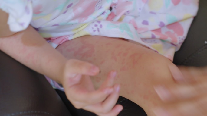 皮疹通常出现在蹒跚学步的女孩腿上。过敏：儿童脸颊发红