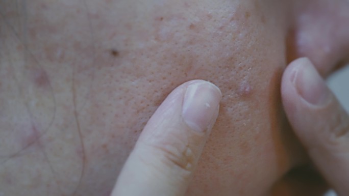 4k-油性皮肤皮肤问题 痘痘 黑头