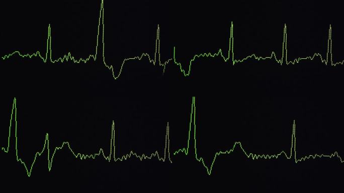 个人使用（家用）ECG上显示的不规则心律的心脏心电图