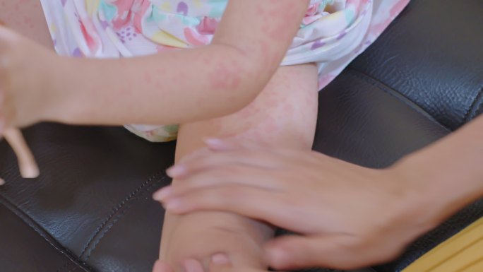 母亲正在给女儿涂乳液。皮疹通常出现在蹒跚学步的女孩身上。过敏：儿童脸颊发红