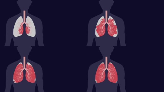 病毒或癌症在具有复制空间的肺中攻击