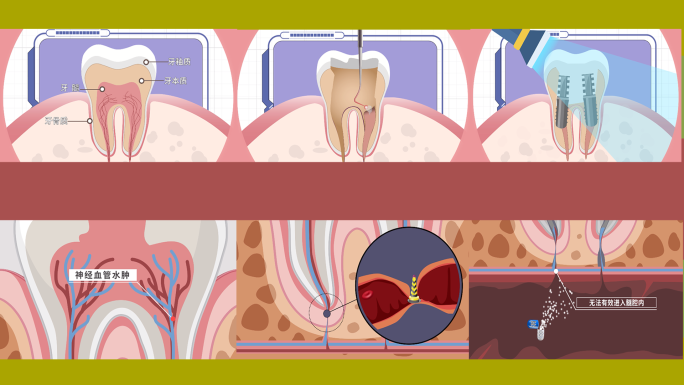 口腔牙齿根管治疗mg动画
