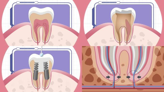 口腔牙齿根管治疗mg动画