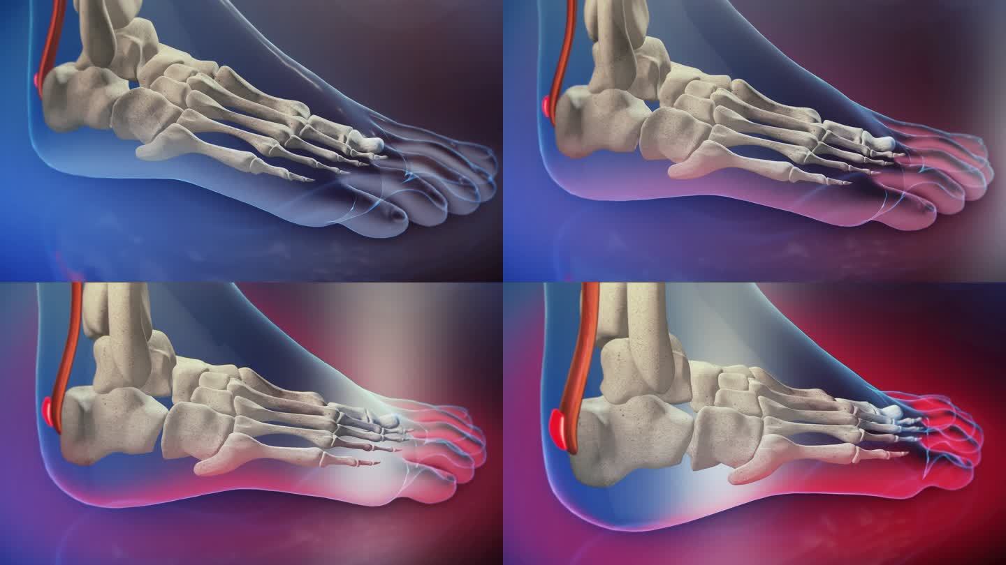 跟腱炎3D动画透视骨科