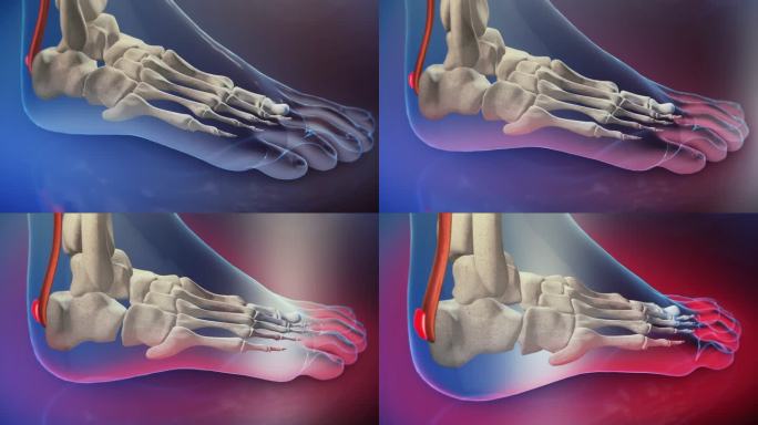 跟腱炎3D动画透视骨科