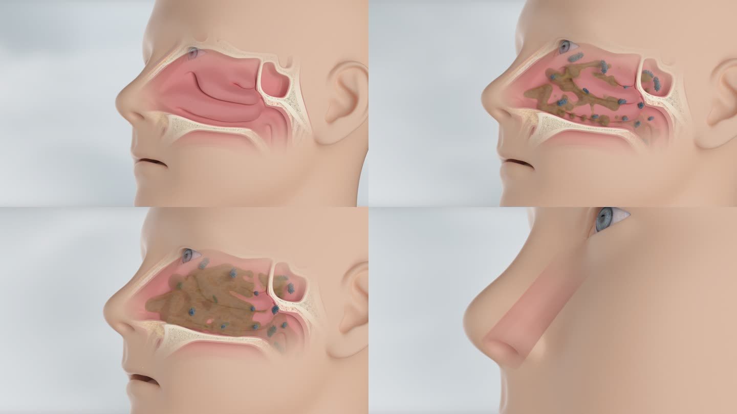 鼻炎鼻子堵塞 过敏性鼻炎 季节性鼻炎鼻炎