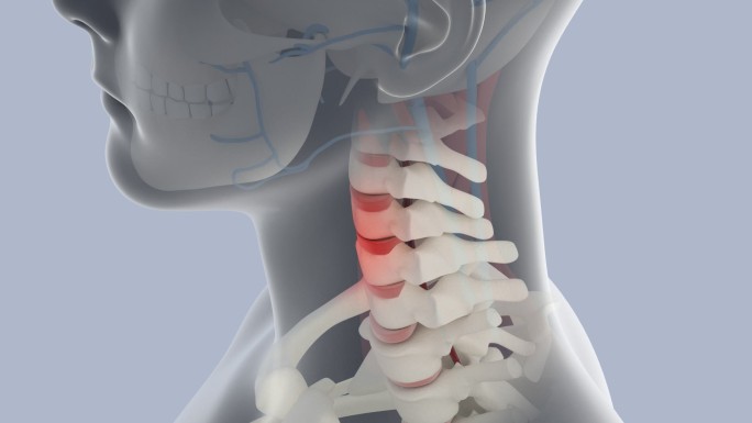 颈椎病 颈椎 骨骼 人体 颈椎骨质增生