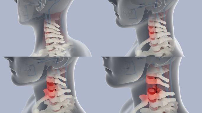 颈椎病 颈椎 骨骼 人体 颈椎骨质增生