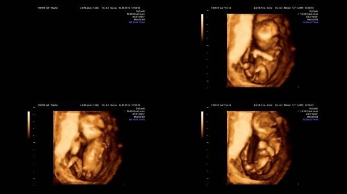 婴儿超声波怀孕孕检B超检查小生命发育情况