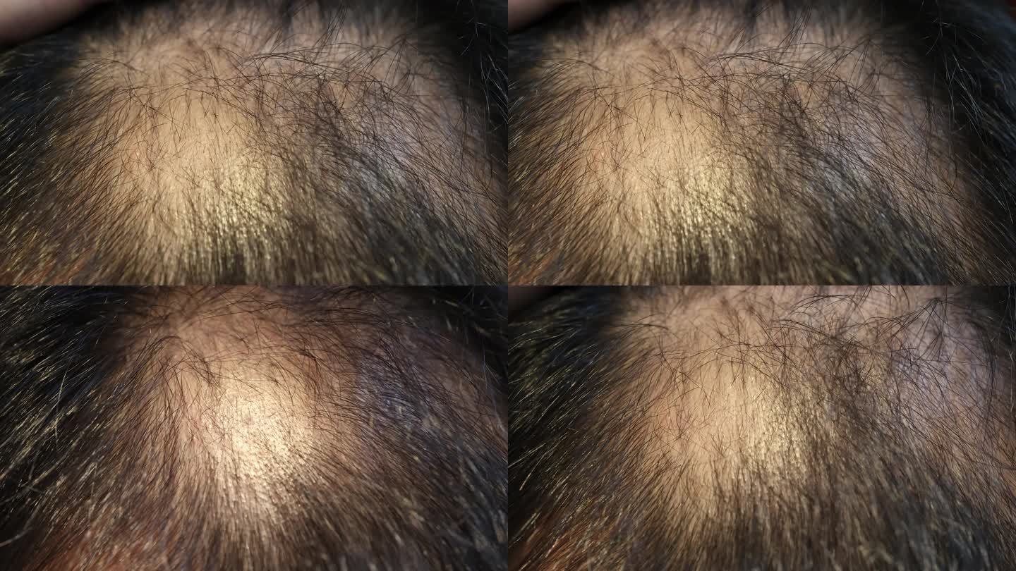 秃顶脱发脂溢性脱发雄激素脱发2