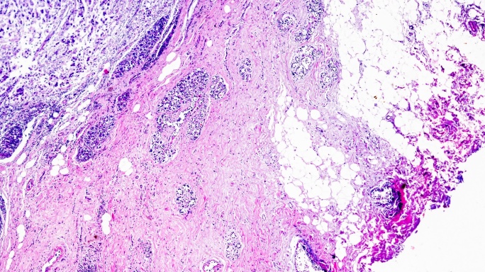 乳腺腺纤维瘤在光学显微镜下不同区域放大