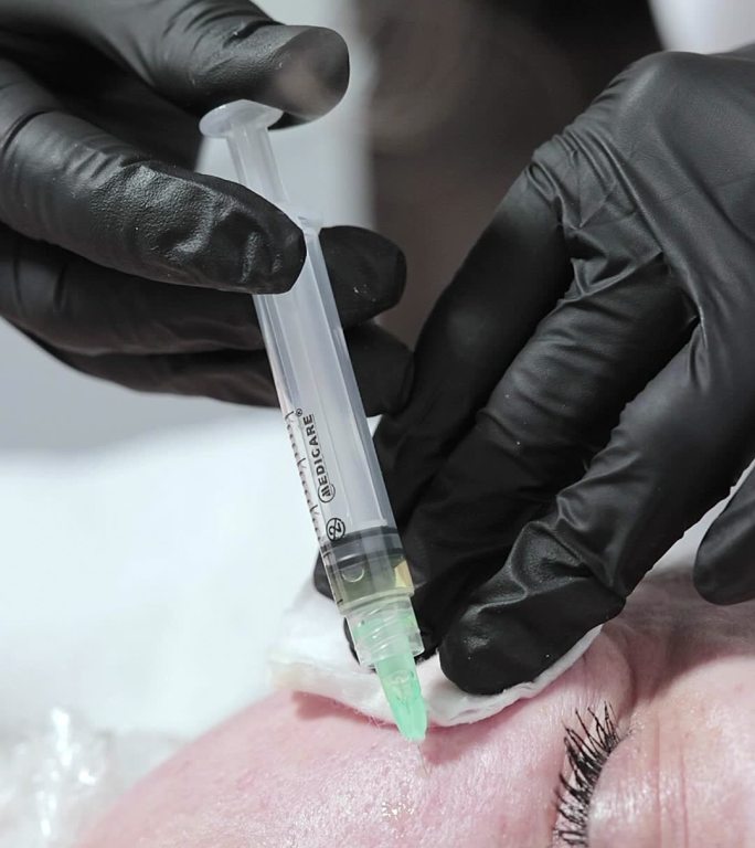 美容师在一个女人的脸上注射一种皮肤恢复活力的药物。