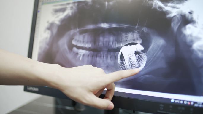 看x光片的牙医拔牙智齿特写影像种牙门诊