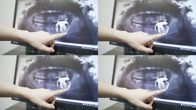 看x光片的牙医拔牙智齿特写影像种牙门诊