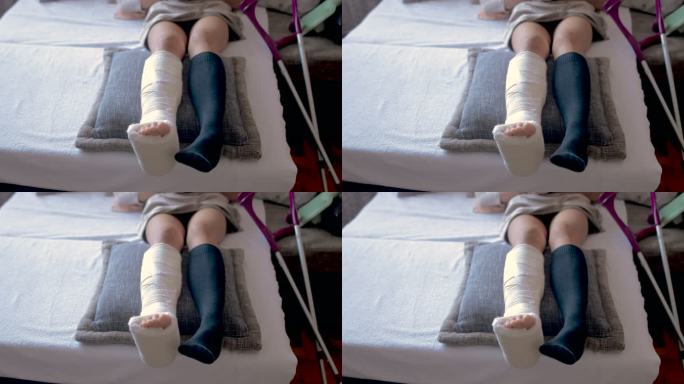 腿部骨折和石膏脚的残疾妇女在家