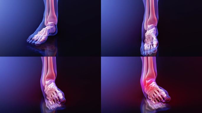 踝关节扭伤-骨骼x线检查。