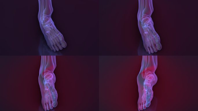 踝关节扭伤-骨骼x线检查。